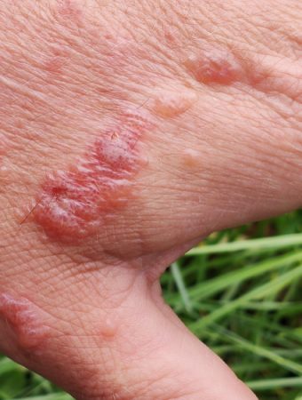 This Invasive Plant Can Cause Severe Skin Burns — Here’s How to Recognize It