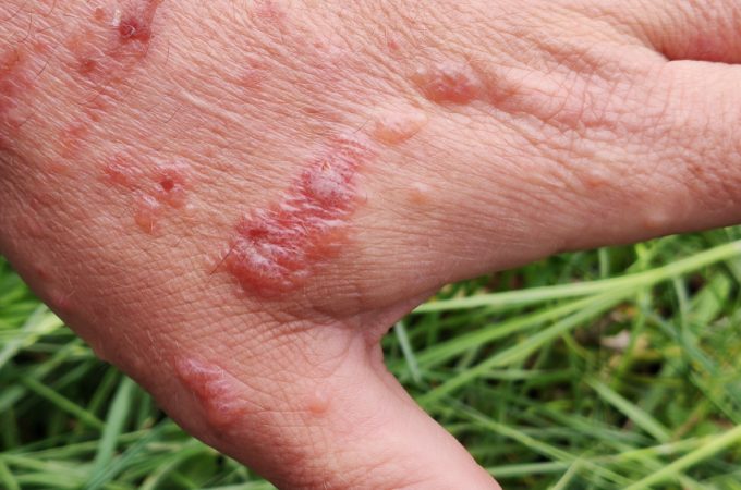 This Invasive Plant Can Cause Severe Skin Burns — Here’s How to Recognize It