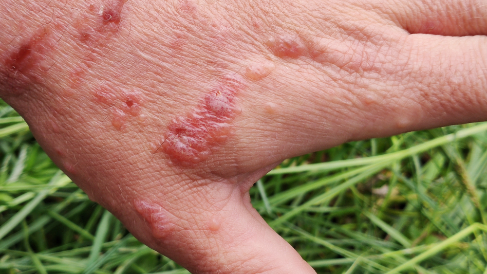 This Invasive Plant Can Cause Severe Skin Burns — Here’s How to Recognize It